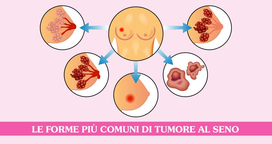 Tumore al seno – approccio integrato
